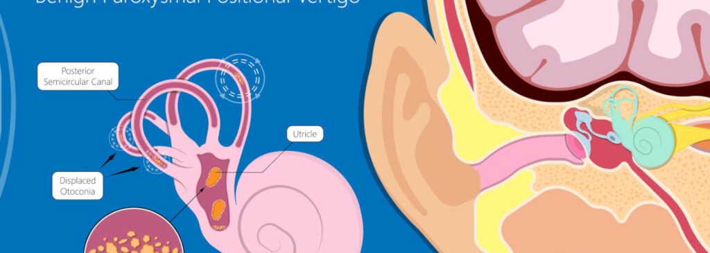 Schema dell'anatomia dell’orecchio interno che mostra il canale semicircolare posteriore coinvolto nella VPPB con otoliti spostati (otoconia) e loro effetto sul sistema vestibolare.