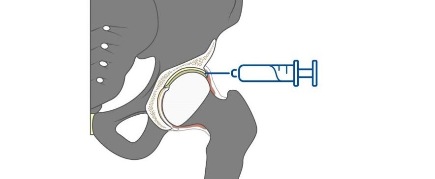 Illustrazione anatomica laterale che mostra l'articolazione dell'anca (testa del femore nell'acetabolo) e un ago di siringa inserito nello spazio articolare per un'infiltrazione.