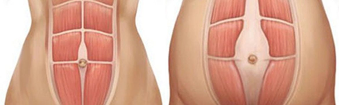 Confronto anatomico tra addome normale e con diastasi addominale, evidenziando la separazione dei muscoli retti.