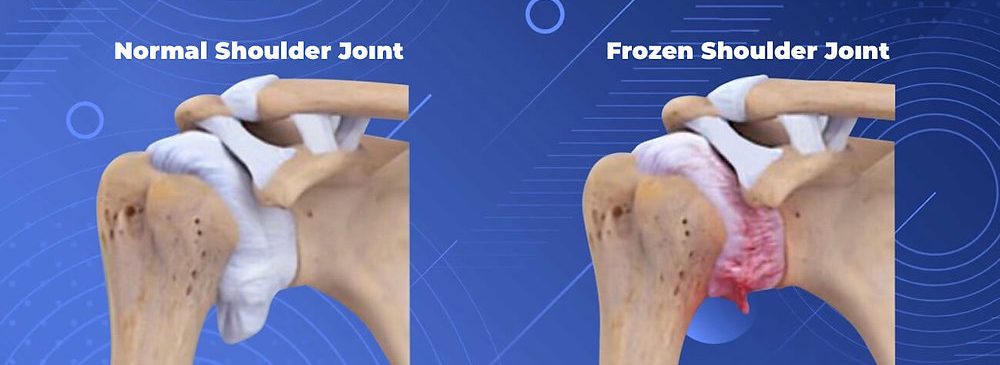 Confronto tra spalla normale e spalla congelata con capsulite adesiva e infiammazione della capsula articolare.