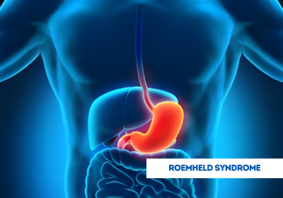 Illustrazione anatomica dello stomaco disteso nella sindrome di Roemheld – connessione gastrica e cardiaca
